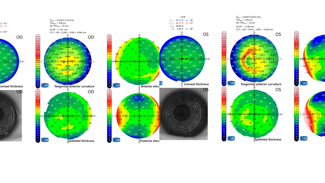 Visually Significant Cataract in the Presence of Corneal Disease