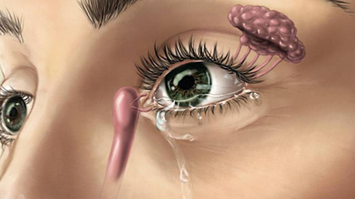 Neurostimulation Offers New Approach to Dry Eye