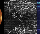 SS OCTA Proves Beneficial to Posterior Uveitis Management