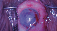 Repeat DSAEK in a Completely Dislocated Failed DSAEK Graft Adhered 360 Degrees to the Iris