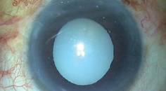 Morgagnian Cataract Presents Technical Challenges