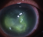 When the Eye Gets Meta Advanced Neurotrophic Keratopathy Secondary to Recurrent Herpes Simplex Keratitis