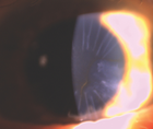 A Patient With Dry AMD Desires Improved Vision