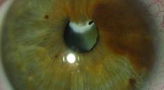 Congenital Cataract With Vascular Synechiae