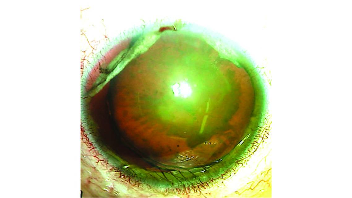 Posttraumatic Subluxated Cataract and Iris Defect