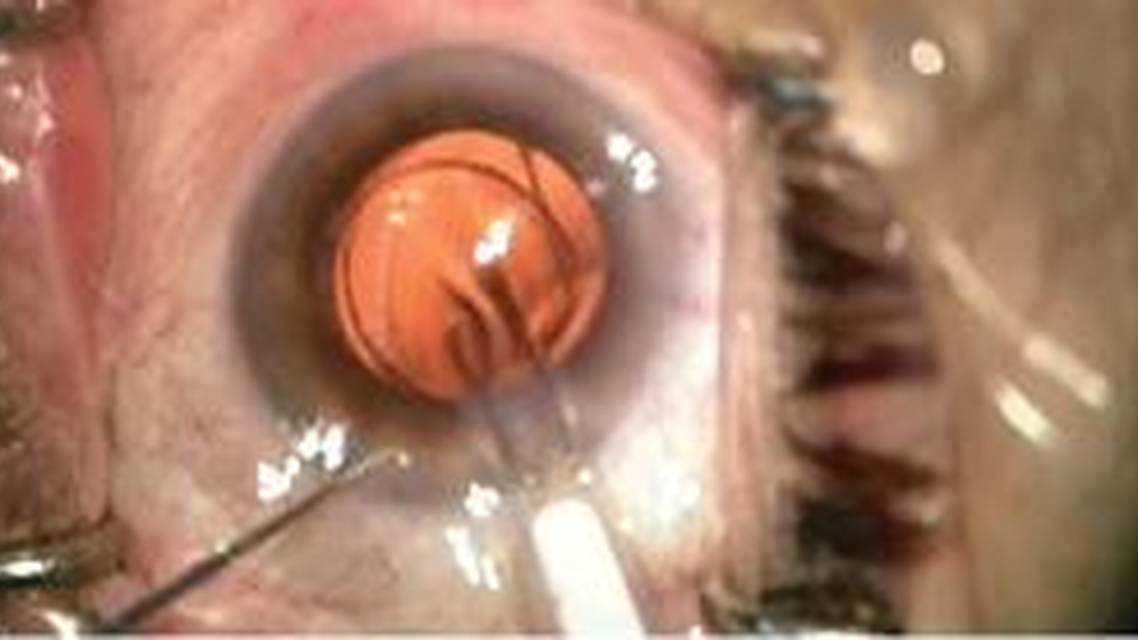 Piggyback IOL as an Enhancement Technique
