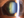 Figure 1. An examination of the left eye reveals a green tint to the lens. The nasal iris defect is difficult to see.
