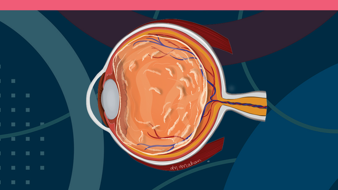 Best Practices on Referring Patients With Symptomatic Vitreous Opacities