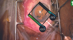 Clear Corneal Incisions