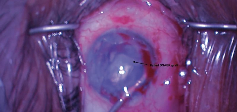 Repeat DSAEK in a Completely Dislocated Failed DSAEK Graft Adhered 360 Degrees to the Iris