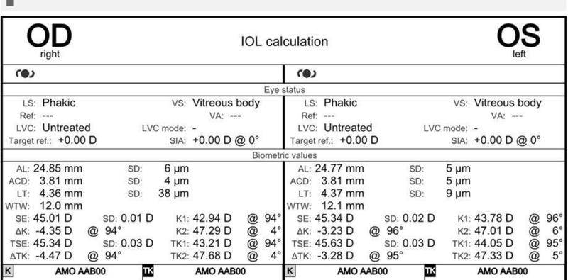 High Astigmatism With Underlying Ectasia