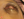 Figure 1. Clinical photograph of the patient upon initial presentation. The left eye demonstrates proptosis, complete corneal opacity, and a central corneal staphyloma with significant conjunctival chemosis and injection with periorbital edema.