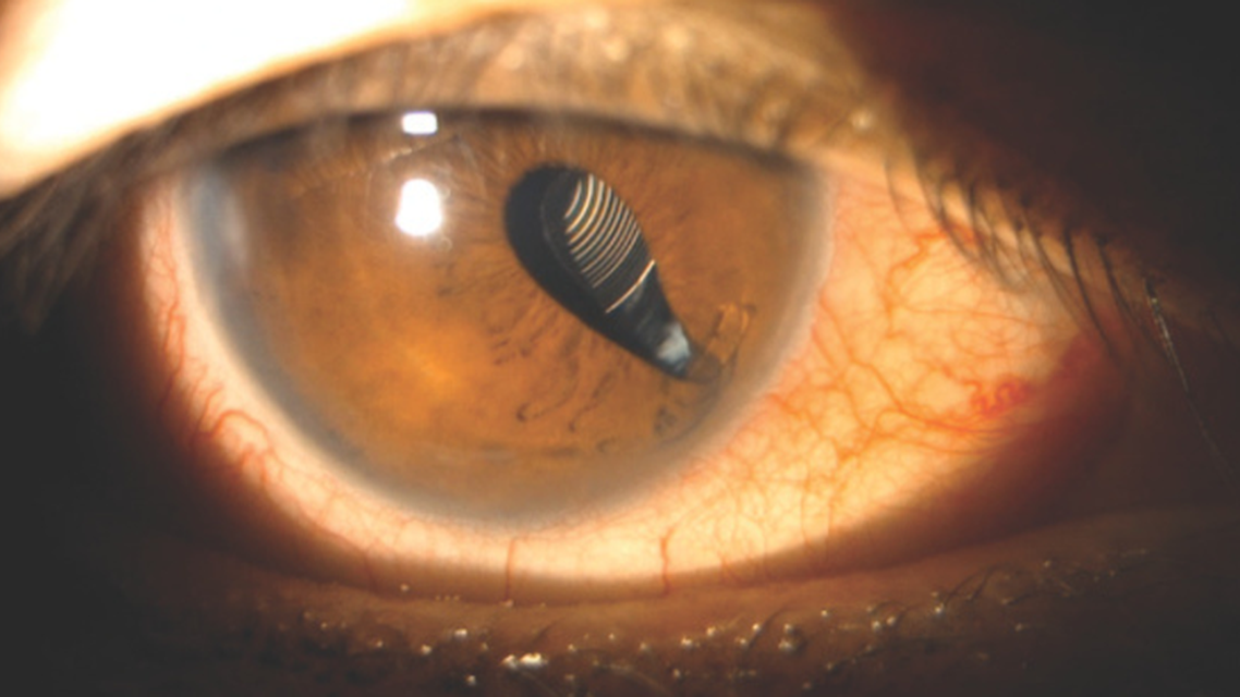 A Traumatically Dislocated but Perfectly Centered Multifocal IOL