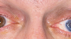 Combined PKP Artificial Iris and Secondary IOL Implantation for Corneal Scar Aniridia and Aphakia Post Traumatic Eye Inju