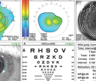 Cataract Management in a Young Adult With a Seizure Disorder