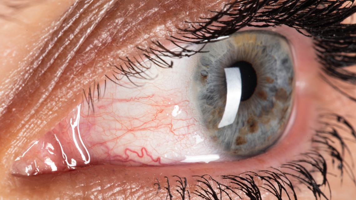 Targeting Inflammation in Dry Eye Disease