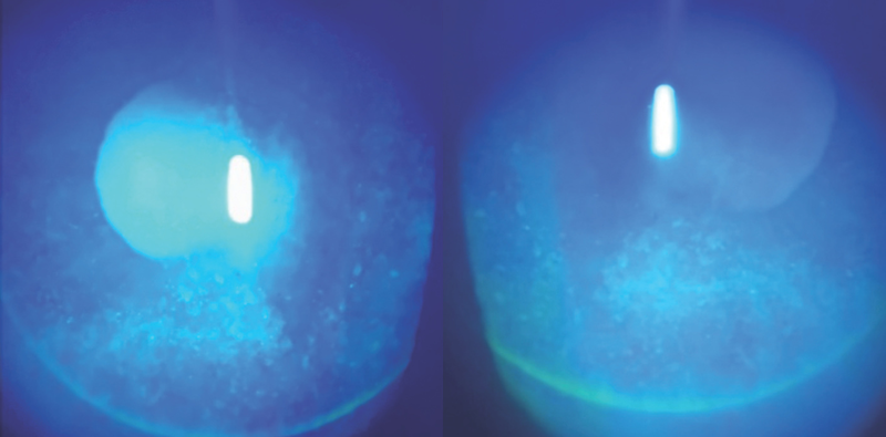 Testing Corneal Sensation Is Important