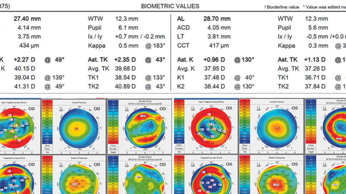 Satisfaction With a Trifocal IOL in One Eye Not Both