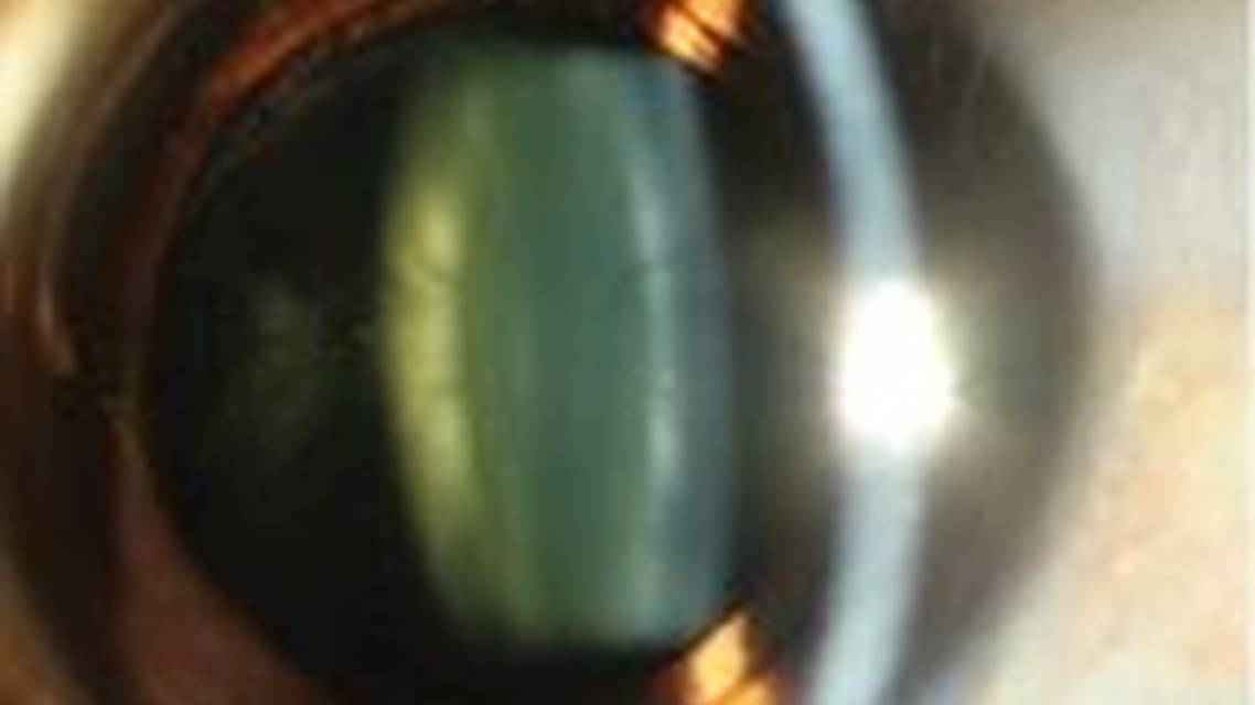 Is Dysfunctional Lens Replacement LASIK For Baby Boomers