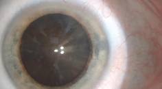 Dense Brunescent Unilateral Cataract