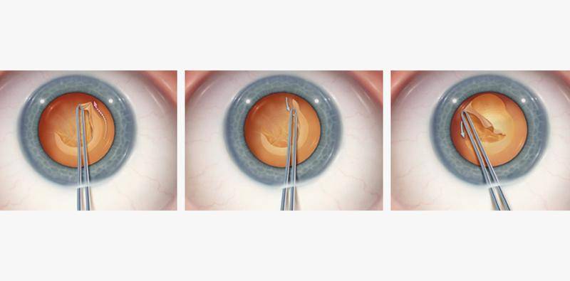 Managing the Errant Capsulorhexis