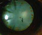 Intralenticular Iron Foreign Body With Lens Siderosis
