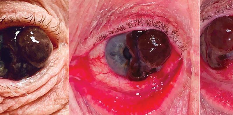 Conjunctival Melanoma
