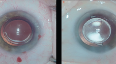 The New ZEISS CT LUCIA 621P IOL