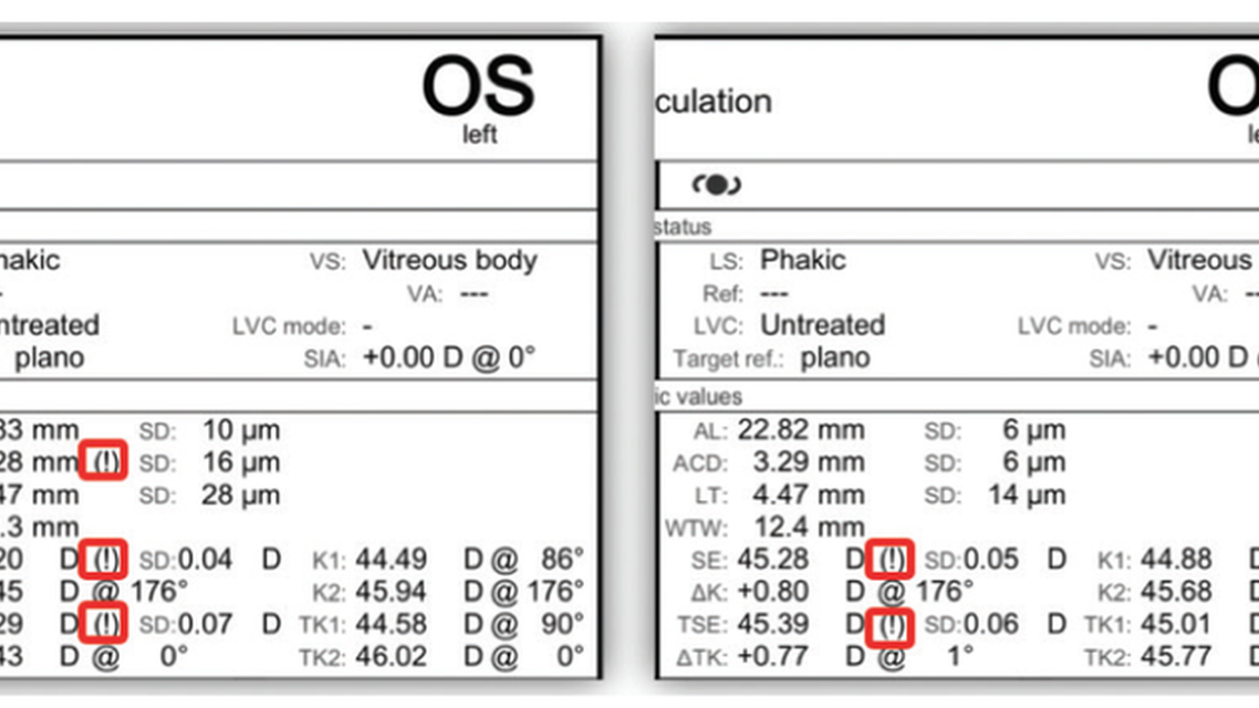 Best Practices in IOL Calculations