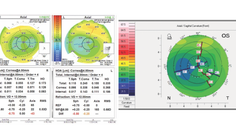 Achieving Spectacle Independence After LASIK