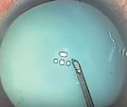 I Dont Have a Femtosecond Laser What Strategies Work Best for a White Cataract