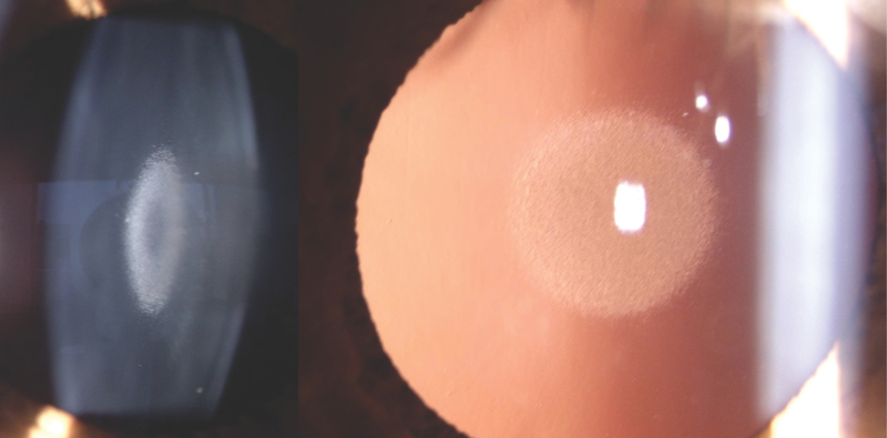 Nuclear Cataracts in a Young Adult