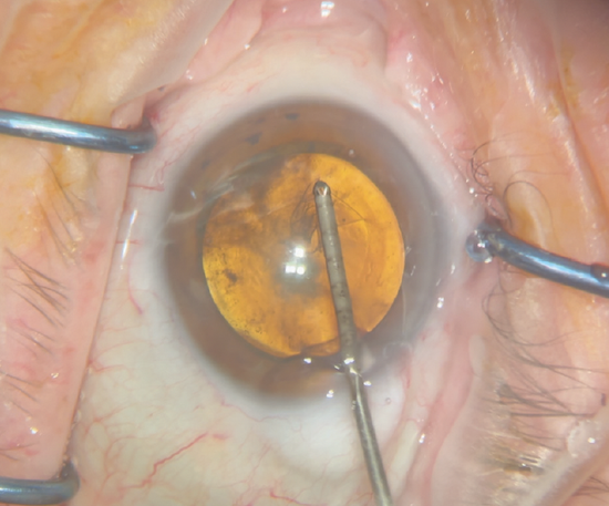 Three Methods for the Capsulotomy