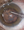 Figure 1. A protective posterior capsular plaque has formed around a PC defect in this post-PPV eye with an acute cataract. The IOL is placed in the bag, and an Nd:YAG laser can be performed at a later date.