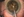 Figure. Dr. Arbisser debulks dense endonucleus during circumferential disassembly and vertical cross-action chopping.