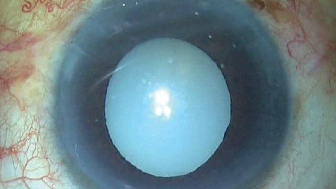 Morgagnian Cataract Presents Technical Challenges