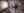 Figure 11. The haptic is cut at its point of adhesion to the iris, and the IOL is safely removed from the eye.