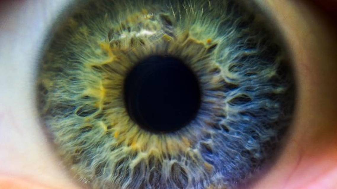 A Custom Iris Prosthesis Finally Gains FDA Approval