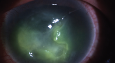 When the Eye Gets Meta Advanced Neurotrophic Keratopathy Secondary to Recurrent Herpes Simplex Keratitis