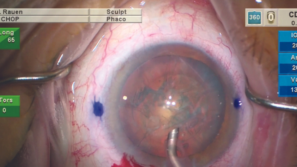 Low IOP Cataract Surgery