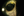 Figure 2. The haptic of a one-piece acrylic lens and surrounding vitreous strands can be seen entrapped in the iris. This patient had a recent history of blunt trauma to the right side of the head as a result of a fall.
