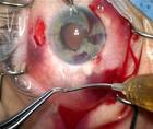 Yamane Technique and Iris Repair in Case of Trauma thumbnail