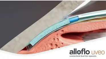 Iantrek Expands Clinical Evidence for AlloFlo Uveo with Two New Peer-Reviewed Publications image