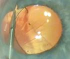 Iris Coloboma