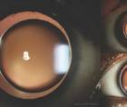 Bilateral Microspherophakia With High Myopia