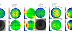 Visually Significant Cataract in the Presence of Corneal Disease