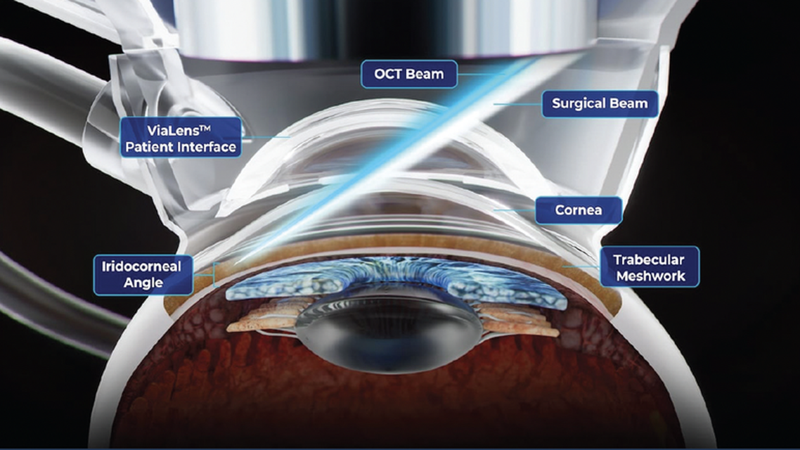 FLIGHT Femtosecond Laser Image Guided High Precision Trabeculotomy