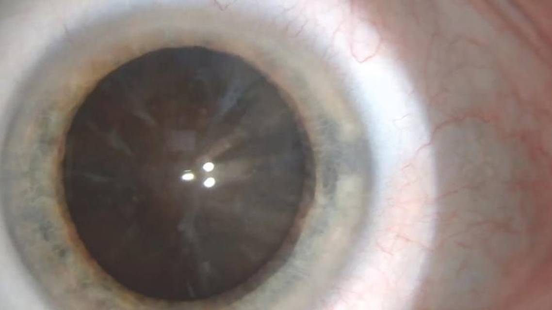 Dense Brunescent Unilateral Cataract