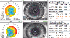 Cataracts and Russian Style Radial Keratotomy