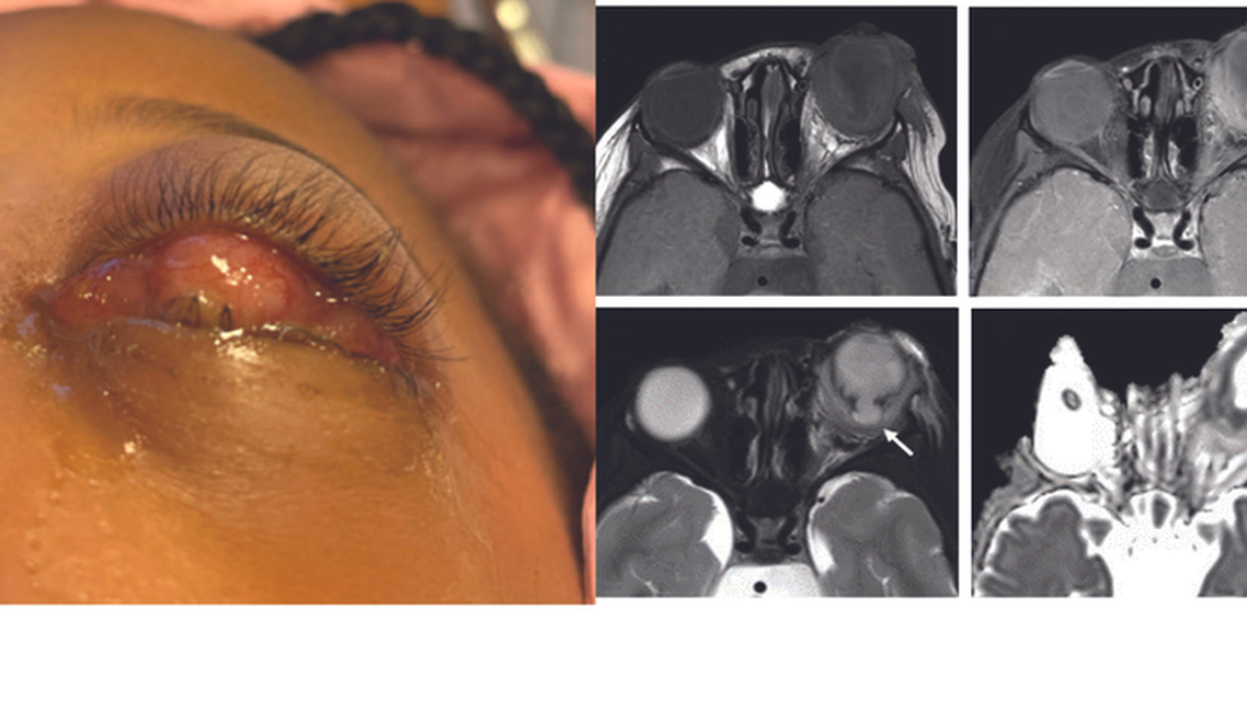 Endophthalmitis in a Patient With Presumed Axenfeld Rieger Syndrome